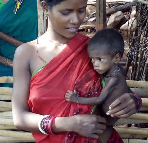 Malnurushed Child in Nagada