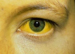 Jaundice
